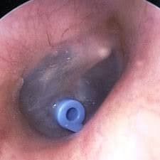Ear Tubes 1