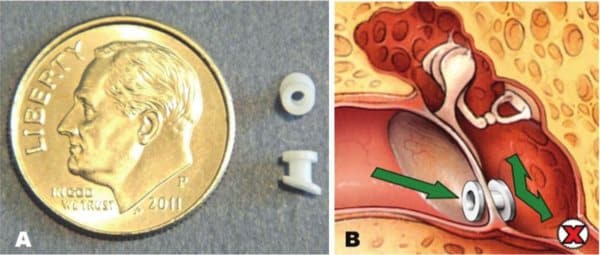 Ear tubes1