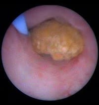 Sialendoscopy1 1