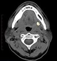 Sialendoscopy2 1
