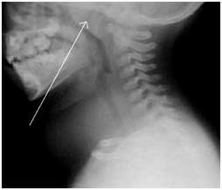 adenoid2