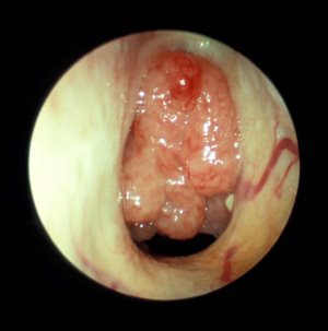 adenoid3