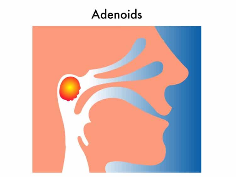 adenoids