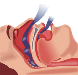 sleep apnea surgery1 (1)