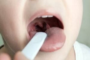 tonsils (1)