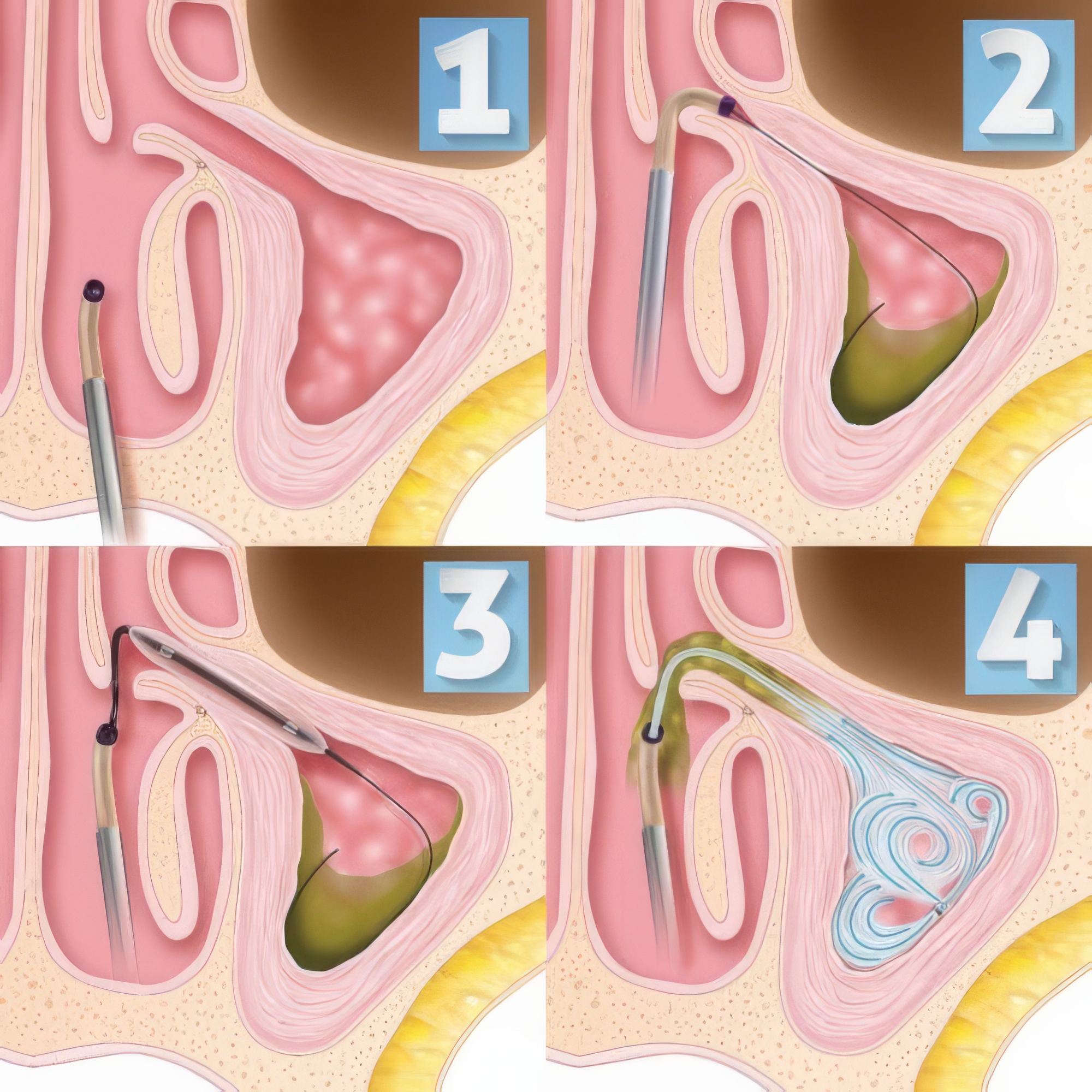 balloon sinuplasty 1 topaz upscale 4x