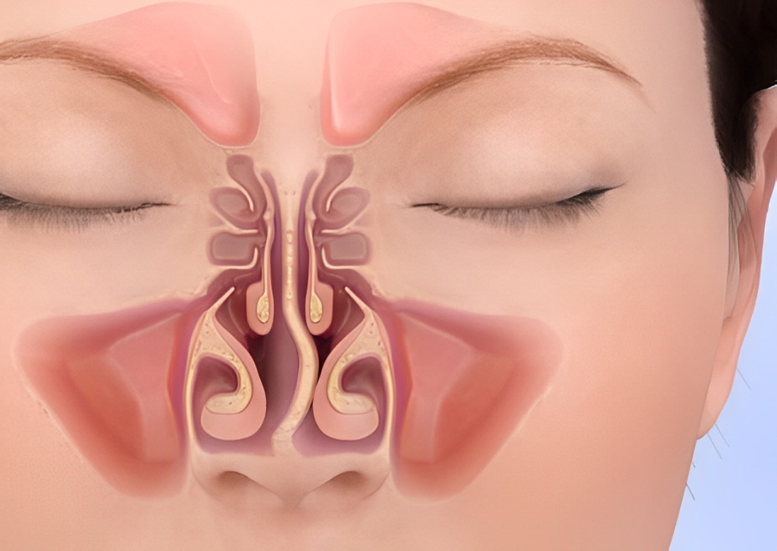 Septoplasty (1)